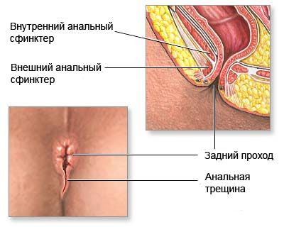 Fissure anal 