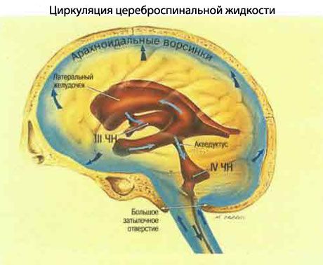 Idiopatik Intrakranial Hipertensi