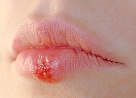 Mengapa herpes "muncul"