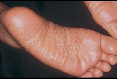 Dermatitis kaki dan penyebabnya