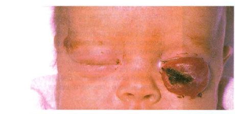 Hemangioma kelopak mata bagian bawah. 