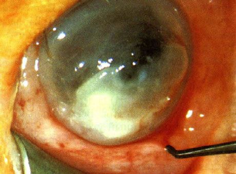 Keratitis disebabkan oleh Pseudomonas pada bayi baru lahir.  Faktor predisposisi tidak teridentifikasi