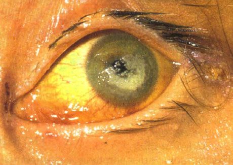 Keratitis bilateral disebabkan oleh Candida pada anak dengan imunodefisiensi berat