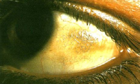 Xerophthalmus.  Plak Bito terlihat tinggi, dengan endapan beberapa sisik, situs konjungtiva berada di zona yang tidak tertutup oleh kelopak mata.  Seperti dalam kasus ini, daerah patologis seringkali berpigmen.