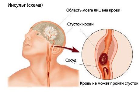 Uji mudah memprediksi stroke fatal