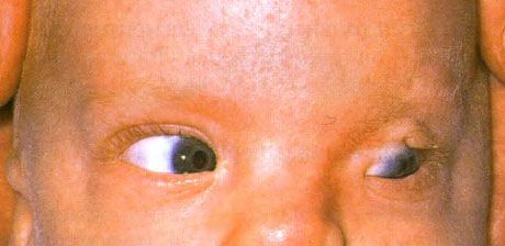 Sindrom Fraser  Cryptophthalmos tidak lengkap dari mata kiri.