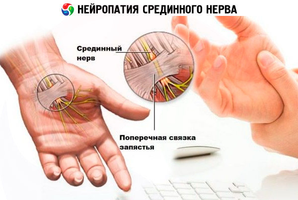  Neuropati  ekstremitas atas gejala pengobatan Kompeten 