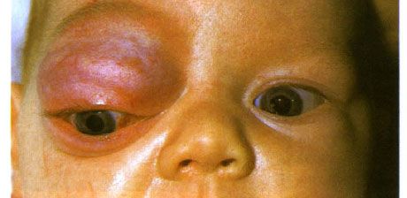 Hemangioma kapiler dari bagian anterior orbit dan kelopak mata bagian atas.  Neoplasma cenderung maju