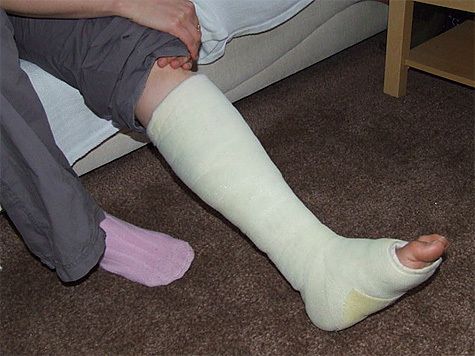 Tindakan di rumah dengan fraktur kaki