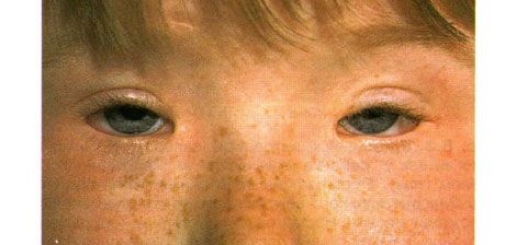 Sindrom blepharophimosis.  Ptosis yang dioperasikan dua sisi, telecanthus dan blepharophimosis