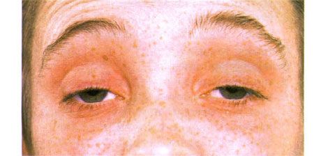 Oftalmoplegia eksternal.  Ptosis dua sisi.  Pasien membuka matanya dengan mengangkat alisnya