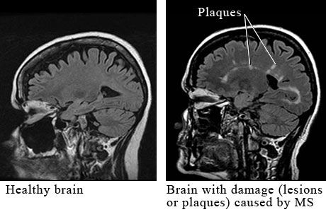 Multiple sclerosis bisa disembuhkan