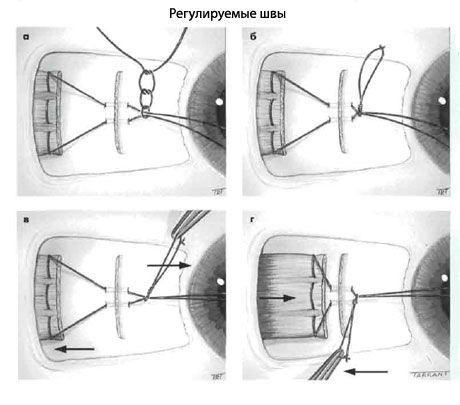 Strabismus - Operasi