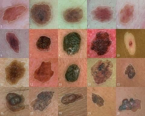 Para ilmuwan telah menemukan gen yang berperan sentral dalam pengembangan melanoma